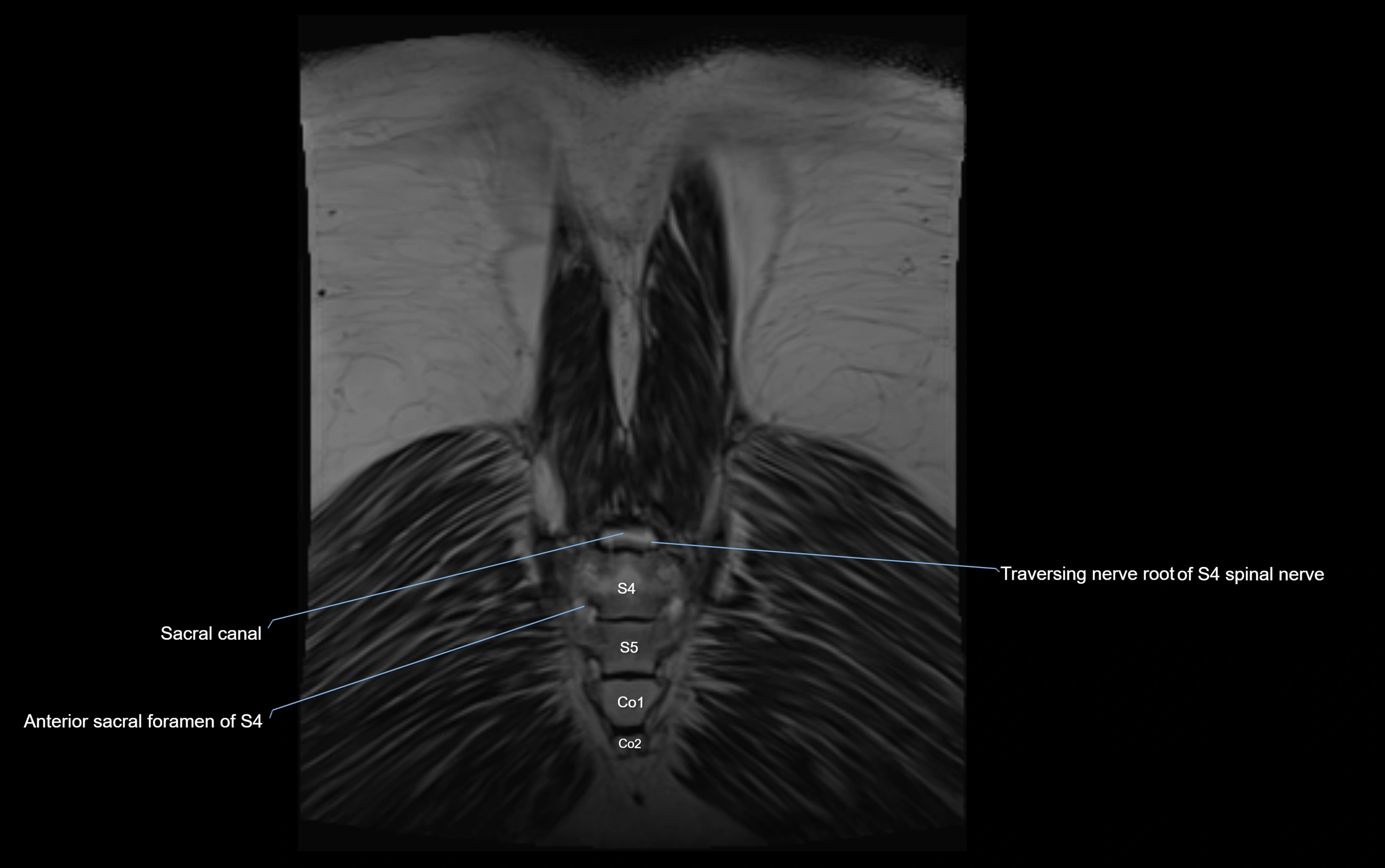 MR lumbosacral plexus cross sectional anatomy 3T  radiology  image-img-09001-00081.webp